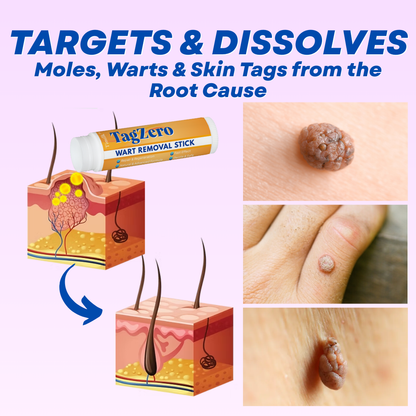 Timilk® TagZero Wart Removal Stick