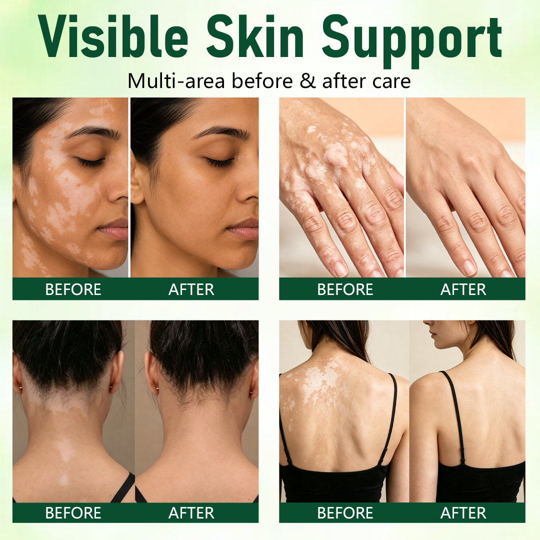 Ceoerty® Herbal Vitiligo Cream (A)