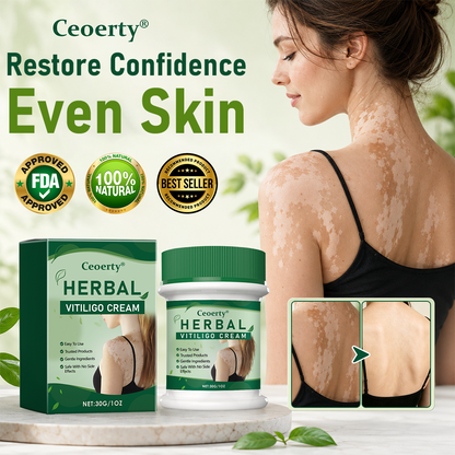 Ceoerty® Herbal Vitiligo Cream (A)