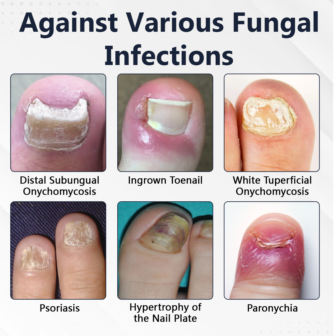 Ceoerty® NailFungiClear Pro Antifungal Pen (A)