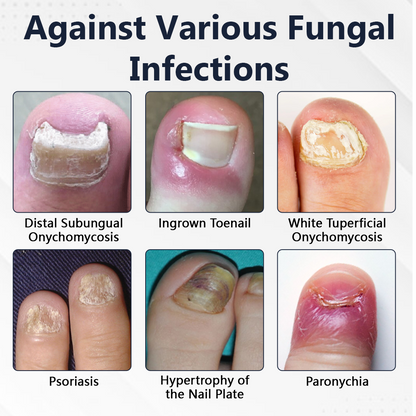Ceoerty® NailFungiClear Pro Antifungal Pen (A)