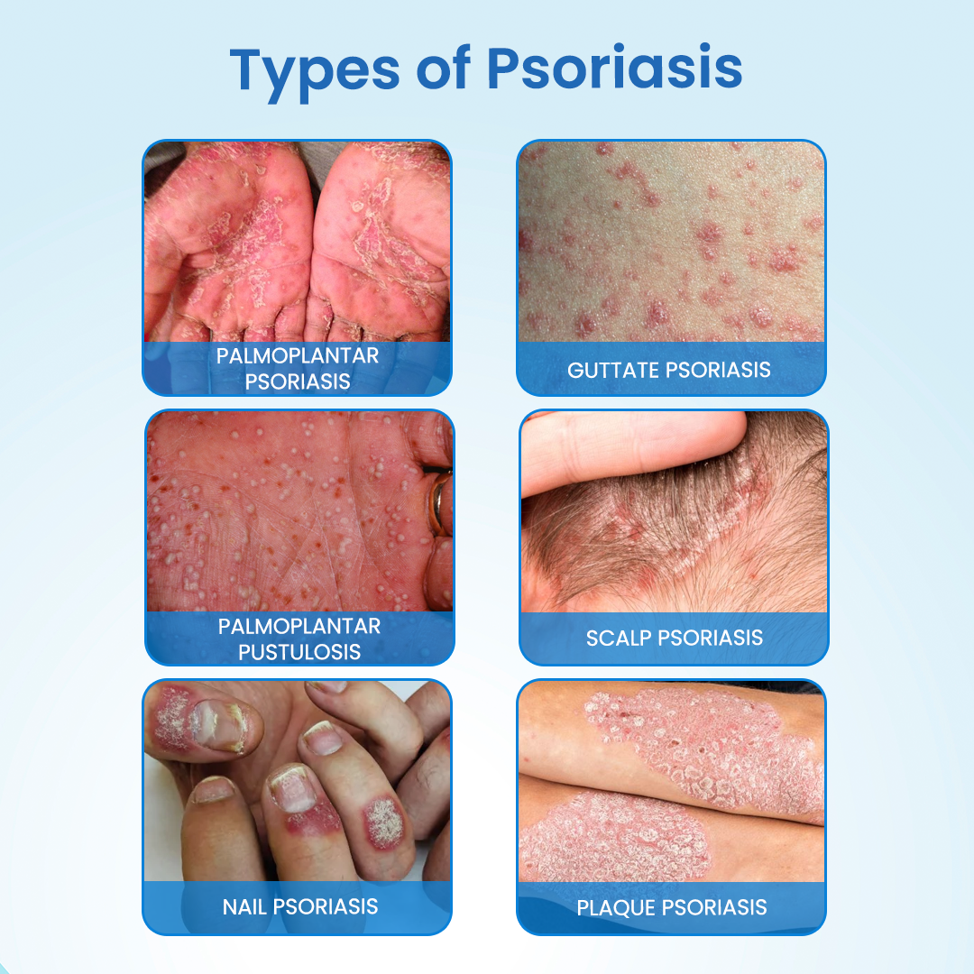 Timilk® MagnesiumHerb Psoriasis Relief Cream (A)
